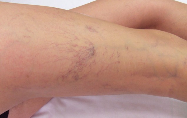 Skleroterapia